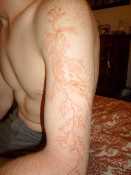 После разряда — что происходит с человеком, в которого ударила молния После разряда — что происходит с человеком, в которого ударила молния